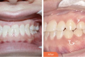 鹽城倍美永康口腔門(mén)診部張蓉整形價(jià)格表附金屬托槽矯正案例展示