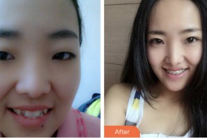 鹽城倍美永康口腔門(mén)診部洪瑛瑛住院醫(yī)師整形價(jià)格表附金屬托槽矯正案例展示