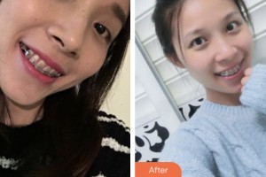 鹽城倍美永康口腔門(mén)診部陸鋒整形價(jià)格表附自鎖托槽矯正案例展示