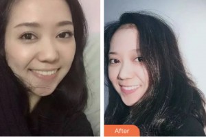 鹽城倍美永康口腔門(mén)診部呂利松整形價(jià)格表附牙齒隱形矯正案例展示