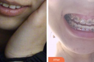 鹽城倍美永康口腔門(mén)診部仇靜靜整形價(jià)格表附金屬托槽矯正案例展示