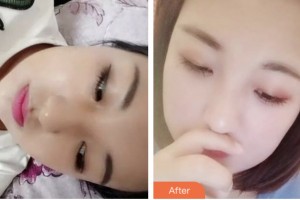 鹽城朝聚眼科醫(yī)院盧新華整形價(jià)格表附埋線(xiàn)雙眼皮案例展示