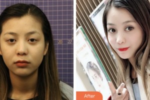 鹽城朝聚眼科醫(yī)院葛軍整形價(jià)格表附切開(kāi)雙眼皮案例展示