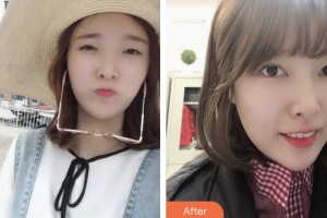 宿遷奧黛麗整形美容門診部韓曉云整形價格表附眼部綜合案例展示