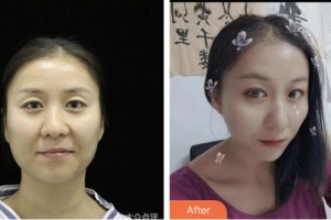 宿遷科以康愛爾五官醫(yī)院閆壽健整形價格表附眼部修復案例展示