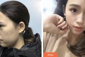 淮安俏美整形美容醫(yī)院朱曉云整形價格表附埋線提升案例展示