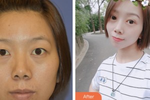 淮安市婦幼保健院醫(yī)療美容科李青國整形價格表附切開雙眼皮案例展示