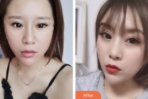 淮安市中醫(yī)院醫(yī)學美容科仲祥西整形價格表附埋線提升案例展示