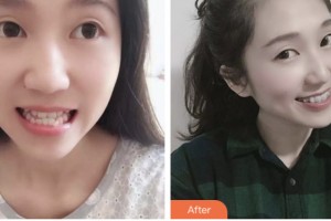 淮安城際口腔醫(yī)院高詩皓整形價格表附自鎖托槽矯正案例展示