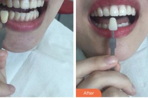 淮安城際口腔醫(yī)院李陽飛整形價格表附美白貼片案例展示