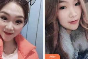 淮安城際口腔醫(yī)院汪仁杰整形價格表附超聲波潔牙案例展示