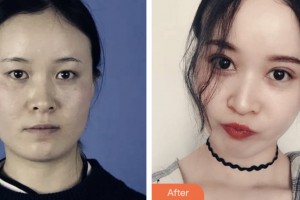 淮安愛(ài)爾眼科醫(yī)院李文化整形價(jià)格表附切開(kāi)雙眼皮案例展示