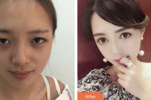 淮安光明眼科醫(yī)院劉慶準(zhǔn)整形價(jià)格表附切開(kāi)雙眼皮案例展示