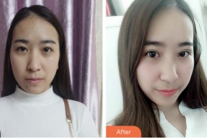 淮安光明眼科醫(yī)院劉巨平整形價(jià)格表附切開(kāi)雙眼皮案例展示