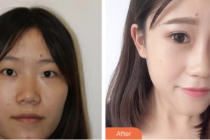 婁底德美醫(yī)療整形美容診所曾良生整形價(jià)格表附埋線雙眼皮案例展示