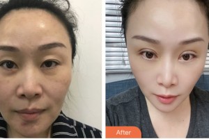 婁底美科醫(yī)療美容門診部（原婁底華美整形美容醫(yī)院）俞勝英 整形價(jià)格表附眼部綜合案例展示