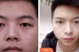 婁底市中心醫(yī)院整形美容科劉自飛整形價(jià)格表附切開雙眼皮案例展示