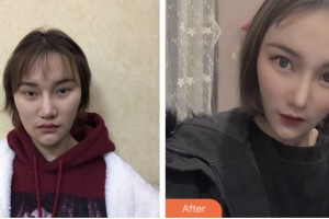 婁底愛思特醫(yī)療美容醫(yī)院謝勁松整形價(jià)格表附肋軟骨隆鼻案例展示