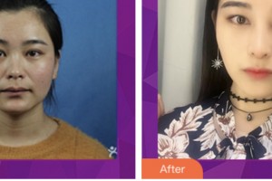 婁底愛思特醫(yī)療美容醫(yī)院王昌松整形價(jià)格表附硅膠隆鼻案例展示