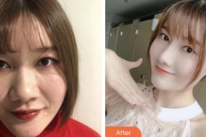 婁底愛思特醫(yī)療美容醫(yī)院劉珊珊整形價(jià)格表附耳軟骨復(fù)合隆鼻案例展示