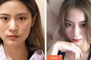 湘潭華雅整形美容醫(yī)院馮潤川整形價(jià)格表附鼻部綜合案例展示