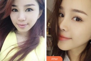 湘潭雅美醫(yī)療美容醫(yī)院田芳斌整形價(jià)格表附硅膠隆鼻案例展示