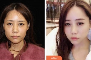 荊門中翰整形美容醫(yī)院溫成平整形價格表附埋線提升案例展示