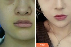 荊門中翰整形美容醫(yī)院李小丹整形價格表附埋線提升案例展示