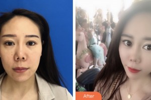 荊門中翰整形美容醫(yī)院胡文亞整形價格表附埋線提升案例展示