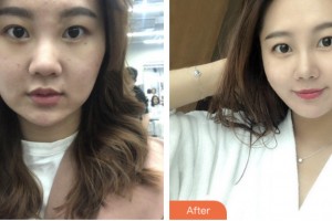 荊門中翰整形美容醫(yī)院劉俊整形價格表附超聲提拉案例展示