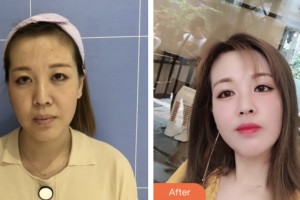 荊門市第二人民醫(yī)院醫(yī)學整形美容中心金娟娟整形價格表附埋線提升案例展示