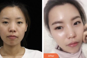 荊門市第二人民醫(yī)院醫(yī)學整形美容中心王金波整形價格表附熱瑪吉案例展示