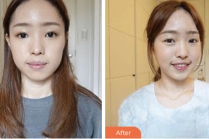 荊門市第二人民醫(yī)院醫(yī)學整形美容中心李成龍整形價格表附埋線提升案例展示