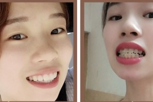 荊門市第二人民醫(yī)院醫(yī)學整形美容中心葉君整形價格表附冷光美白案例展示