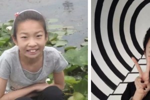 荊門鐘祥佳美醫(yī)療美容門診部趙元杰整形價格表附金屬托槽矯正案例展示