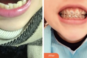 荊門亞貝特口腔醫(yī)院高龍整形價格表附金屬托槽矯正案例展示