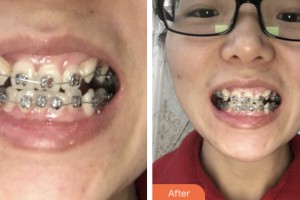 荊門小白兔口腔醫(yī)院李雪明整形價(jià)格表附金屬托槽矯正案例展示