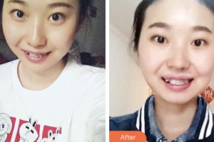 荊門小白兔口腔醫(yī)院杜成整形價(jià)格表附自鎖托槽矯正案例展示