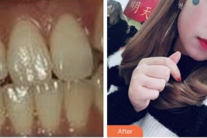 荊門小白兔口腔醫(yī)院王覓整形價(jià)格表附牙齒隱形矯正案例展示