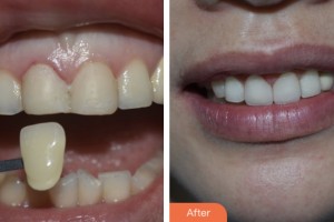 荊門小白兔口腔醫(yī)院朱鑫整形價(jià)格表附牙貼面案例展示