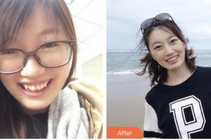 荊門小白兔口腔醫(yī)院謝輝整形價(jià)格表附金屬托槽矯正案例展示