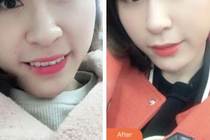 荊門小白兔口腔醫(yī)院黃玲整形價(jià)格表附牙齒隱形矯正案例展示