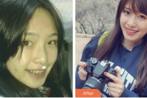 荊門小白兔口腔醫(yī)院蘇軼心整形價(jià)格表附金屬托槽矯正案例展示