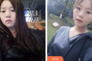 荊門小白兔口腔醫(yī)院朱懷紅整形價(jià)格表附牙齒隱形矯正案例展示