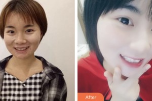 荊門小白兔口腔醫(yī)院陳中浩整形價(jià)格表附牙齒隱形矯正案例展示