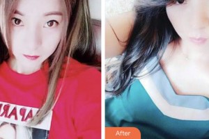 荊門小白兔口腔醫(yī)院徐小蔓整形價(jià)格表附超聲波潔牙案例展示