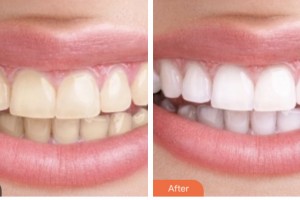 荊門市口腔醫(yī)院董平整形價(jià)格表附金屬托槽矯正案例展示