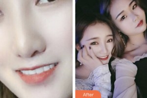 荊門市口腔醫(yī)院劉明海整形價(jià)格表附牙貼面案例展示