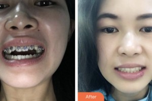荊門市口腔醫(yī)院丁少華整形價(jià)格表附金屬托槽矯正案例展示