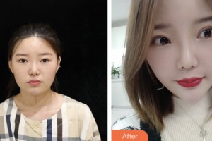 株洲嘉美醫(yī)療整形美容診所李明柱整形價格表附鼻部綜合案例展示